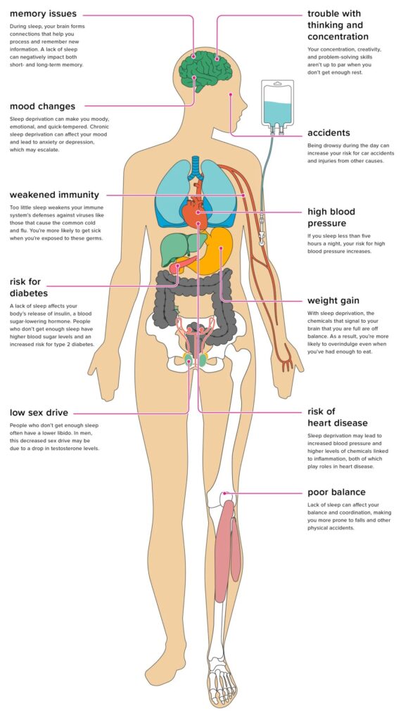 Effects of sleep deprivation